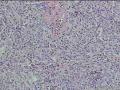 面部肿物图8