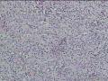 面部肿物图9