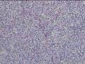 面部肿物图14