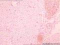 3岁女孩，小脑占位，请老师们看看怎么诊断图5