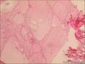 考虑为结节性甲状腺肿伴纤维化钙化囊性变图11