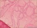 考虑为结节性甲状腺肿伴纤维化钙化囊性变图14