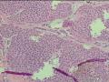 腹股沟肿物图14