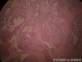 左乳腺肿物,体积1.5cmx1.5cmx1cm,切除活检!图8