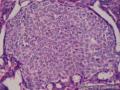 左乳腺肿物,体积1.5cmx1.5cmx1cm,切除活检!图36
