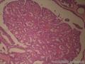 左乳腺肿物,体积1.5cmx1.5cmx1cm,切除活检!图49