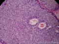 左乳腺肿物,体积1.5cmx1.5cmx1cm,切除活检!图45