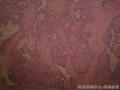 左乳腺肿物,体积1.5cmx1.5cmx1cm,切除活检!图6