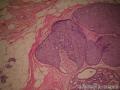 左乳腺肿物,体积1.5cmx1.5cmx1cm,切除活检!图33