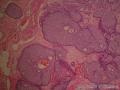 左乳腺肿物,体积1.5cmx1.5cmx1cm,切除活检!图44