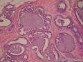 左乳腺肿物,体积1.5cmx1.5cmx1cm,切除活检!图35