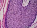 左乳腺肿物,体积1.5cmx1.5cmx1cm,切除活检!图41