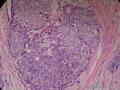 左乳腺肿物,体积1.5cmx1.5cmx1cm,切除活检!图5