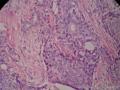 左乳腺肿物,体积1.5cmx1.5cmx1cm,切除活检!图7