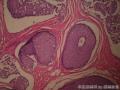 左乳腺肿物,体积1.5cmx1.5cmx1cm,切除活检!图40