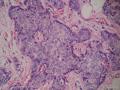 左乳腺肿物,体积1.5cmx1.5cmx1cm,切除活检!图27