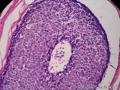 左乳腺肿物,体积1.5cmx1.5cmx1cm,切除活检!图42