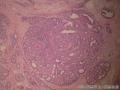 左乳腺肿物,体积1.5cmx1.5cmx1cm,切除活检!图22