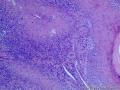 臀部皮肤  T淋巴瘤,蕈样霉菌病？图7