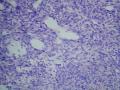 直肠系膜囊肿-上海市骨与关节肿瘤读片2013（2-8）-同济大学附属同济医院提供图4