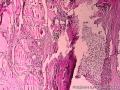 甲状腺肿瘤图15