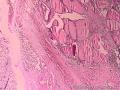 甲状腺肿瘤图16