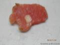 甲状腺微小癌图1