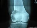 右股骨下端肿物图1