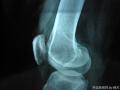 右股骨下端肿物图2