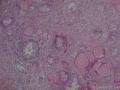 亚急性甲状腺炎？图15