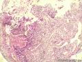 印戒细胞癌？粘液腺癌？图3