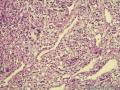 印戒细胞癌？粘液腺癌？图13