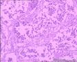 子宫内膜样腺癌图10