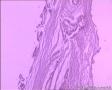 子宫内膜样腺癌图19