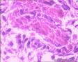 子宫内膜样腺癌图17