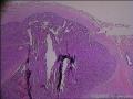 男性乳腺，乳头状肿瘤，局部伴原位癌可以么图23