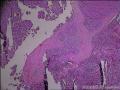男性乳腺，乳头状肿瘤，局部伴原位癌可以么图25