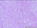 左足背肿块图8