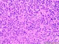 淋巴结猫爪病？坏死性淋巴结炎？or非特异性炎症？图5