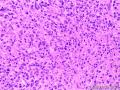 淋巴结猫爪病？坏死性淋巴结炎？or非特异性炎症？图6