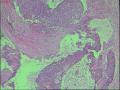 背部肿物图23