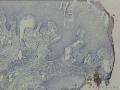 舌体肿物图3