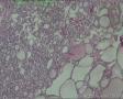 甲状腺腺瘤样变？增生复旧不一？还是其他？图3