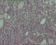 甲状腺腺瘤样变？增生复旧不一？还是其他？图22