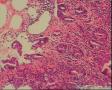 胃窦部胃镜活检图10