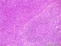 转移癌？淋巴瘤？图10