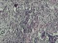 直肠活检，腺癌？没问题吧图12
