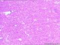 甲状腺什么肿瘤？图6