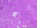 甲状腺什么肿瘤？图30