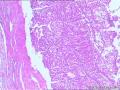 甲状腺什么肿瘤？图4